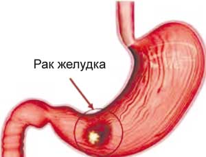 Рак желудка